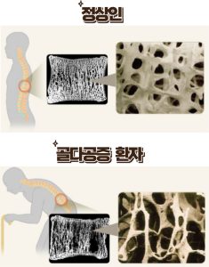 골다공증 예방을 위한 10대 생활수칙(건강한 뼈 유지법) 2 골다공증 예방을 위한 10대 생활수칙(건강한 뼈 유지법)