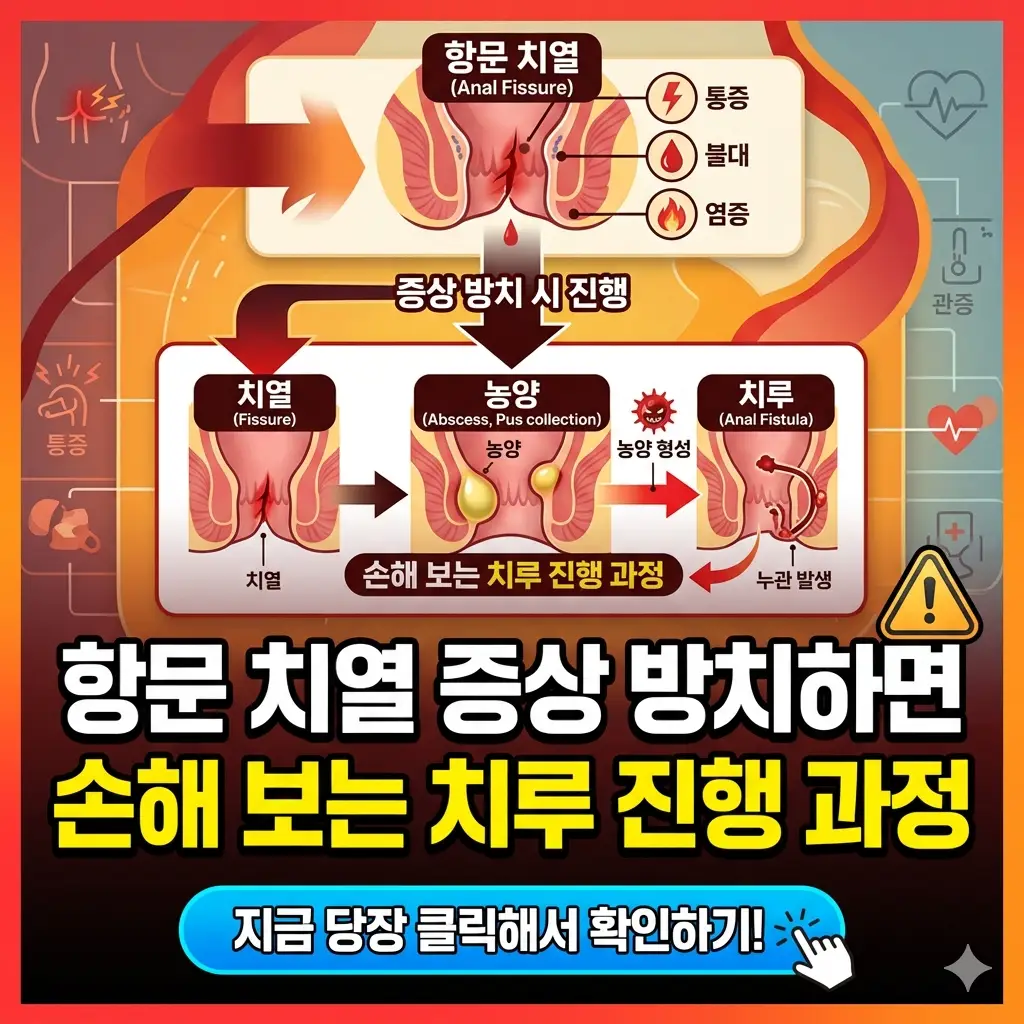 항문 치열 증상을 방치했을 때 치루로 진행되는 과정을 설명하는 건강 정보 썸네일