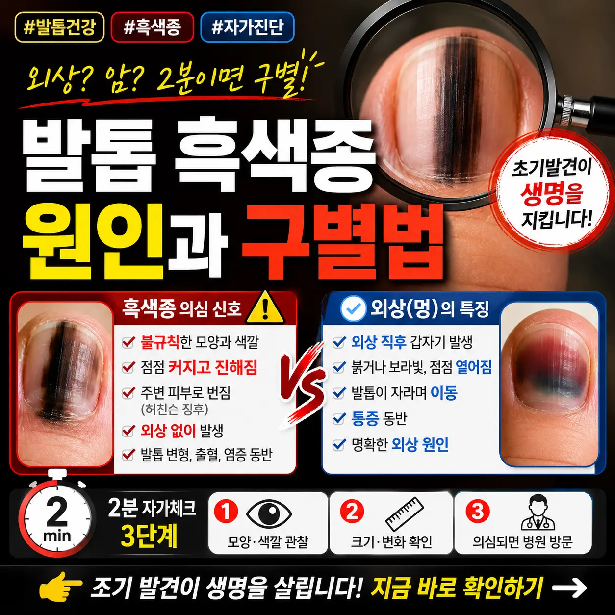 발톱의 검은 줄을 외상 멍과 흑색종 위험 신호로 비교한 건강 정보 썸네일.